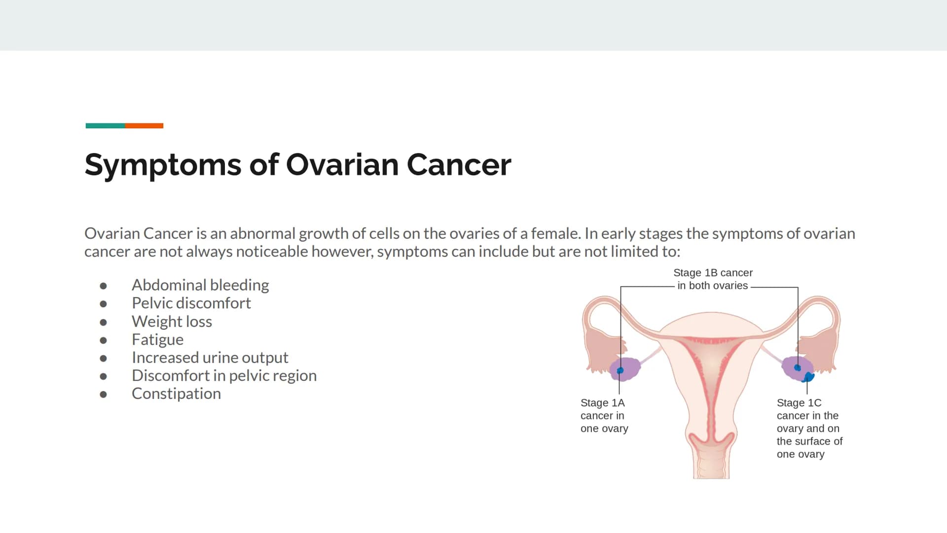 Natural History of Ovarian
Cancer
A presentation by Nicole Guevara Symptoms of Ovarian Cancer
Ovarian Cancer is an abnormal growth of cells 