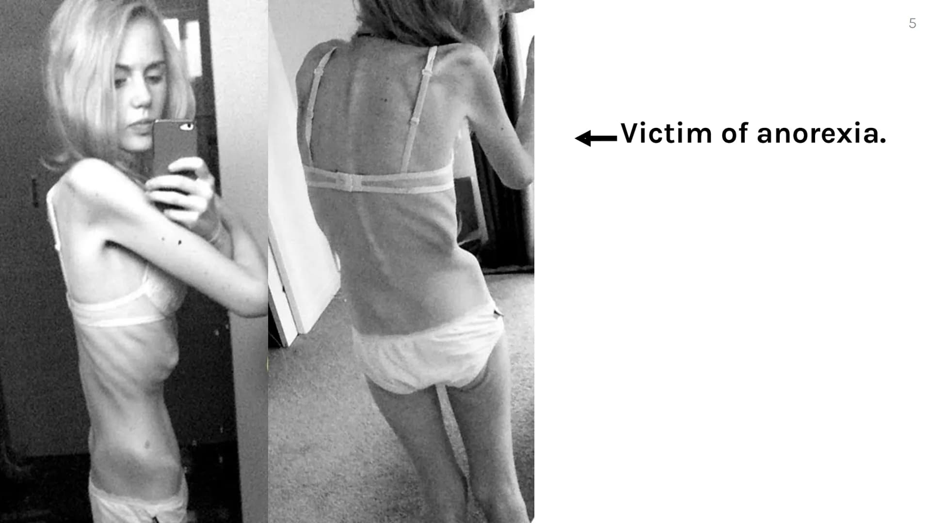 Anorexia
By: Kate Bicalho What is Anorexia?
Eating disorder
★
Scientifically called Anorexia Nervosa (AN)
A condition where people see thems