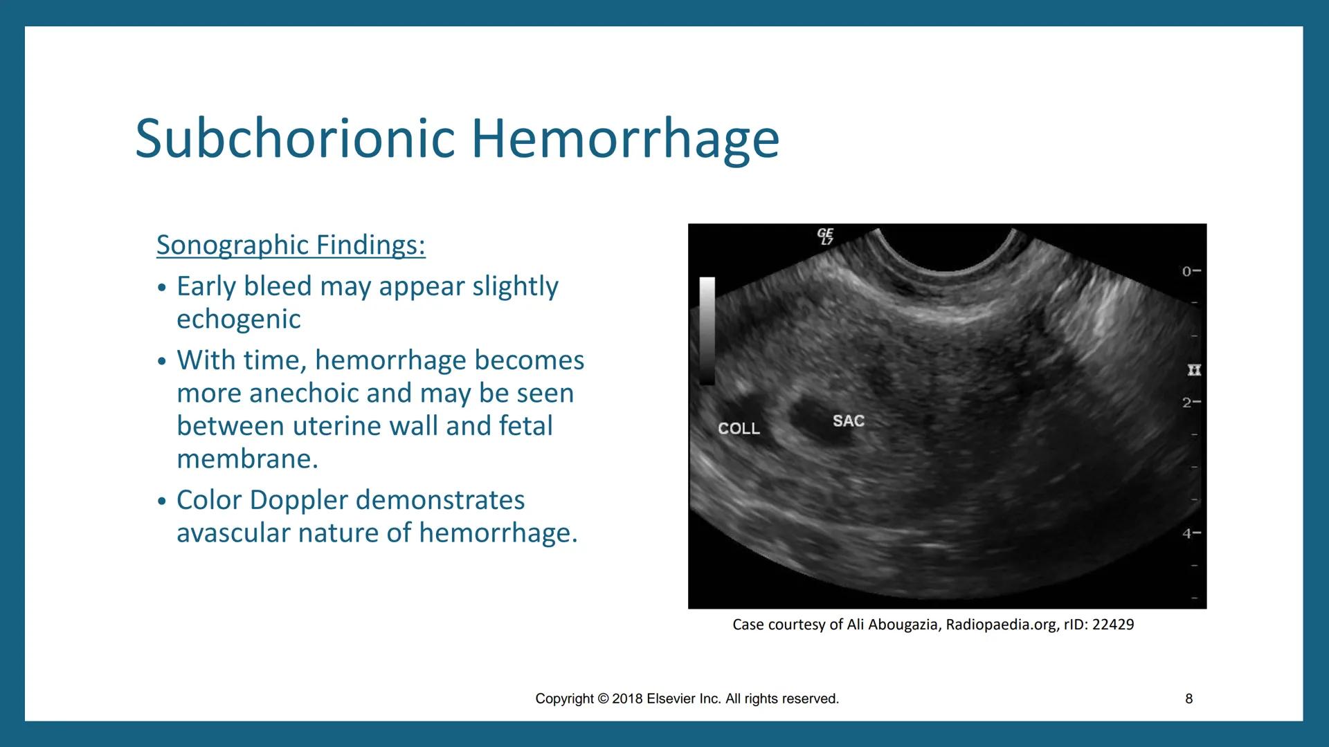 FIRST-TRIMESTER
COMPLICATIONS
DMS 202 - OBGYN Sonography I
Fall 2024
Chapter 50
Copyright 2018 Elsevier Inc. All rights reserved. Outline
•
