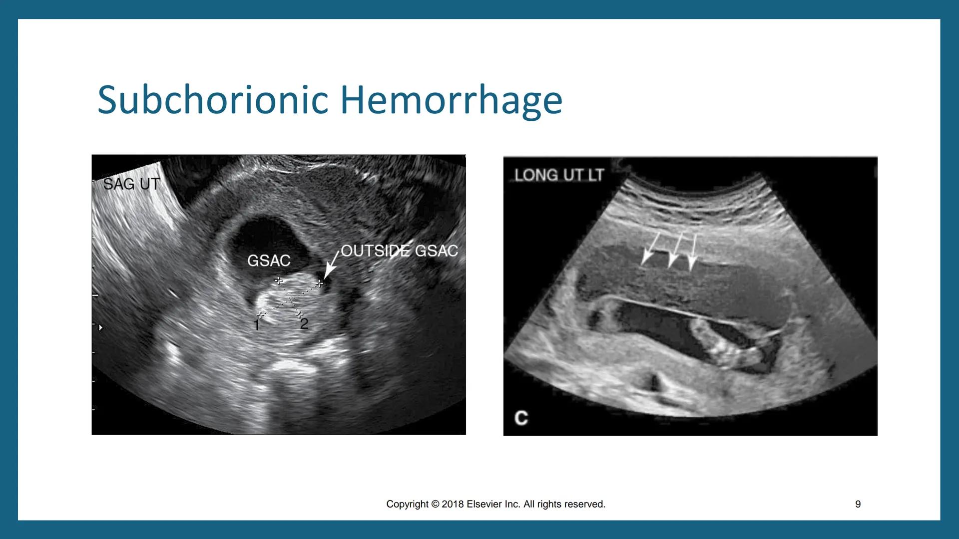 FIRST-TRIMESTER
COMPLICATIONS
DMS 202 - OBGYN Sonography I
Fall 2024
Chapter 50
Copyright 2018 Elsevier Inc. All rights reserved. Outline
•
